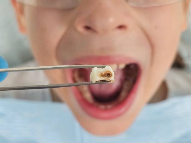 Best Emergency Tooth Extraction in Baiting Hollow, NY